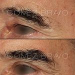Lateral Brow Lift 2