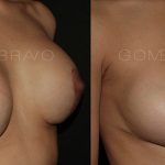 Secondary Breast Surgery 6
