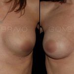Secondary Breast Surgery 3