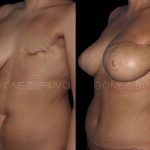 Breast Reconstruction 2