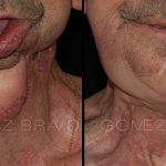 Facial Reconstruction Surgery 10