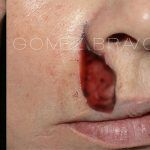 Facial Reconstruction Surgery 8