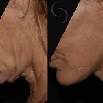 Facelift and Neck Lift 20