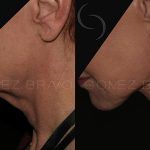 Facelift and Neck Lift 21