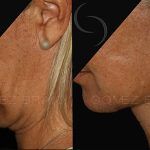 Double Chin Correction 12