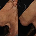 Facelift and Neck Lift 14