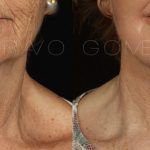 Facelift and Neck Lift 8