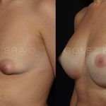 Breast Augmentation 13