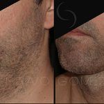 Double Chin Correction 6