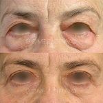 Eyelid Surgery 8
