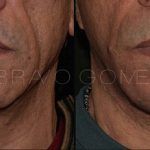 Facelift and Neck Lift 5