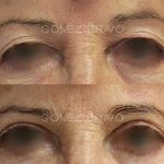 Eyelid Surgery 6