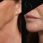 Facelift and Neck Lift 4