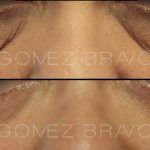 Eyelid Surgery 14