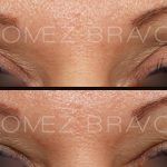 Eyelid Surgery 11