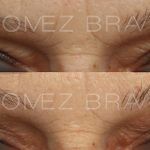Eyelid Surgery 12