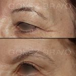 Lateral Brow Lift