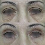 Eyelid Surgery 9
