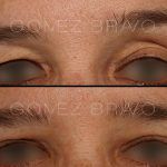Eyelid Surgery 3